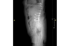 Deformità scoliotica - TC colonna lombo-sacrale senza contrasto 1