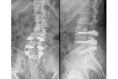 Pre operatorio: scoliosi già trattata chirurgicamente con fissazione e PLIF (Lumbar lordosis 25° Coronal Cobb 5° SVA 10.2 cm)