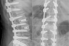 Post operatorio: risultati (Lumbar lordosis 54° Coronal Cobb 1,4° SVA 3.2 cm)