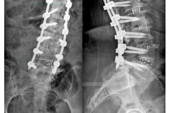 Scoliosi: immagini post operatorie (Lumbar lordosis 59° Coronal Cobb 10° SVA 1,5 cm)