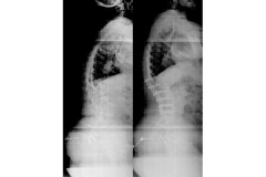 Scoliosi: immagini prima e dopo trattamento con tecnica mininvasiva