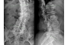 Scoliosi: immagini pre operatorie (Lumbar lordosis 34° Coronal Cobb 21° SVA 6.2 cm)