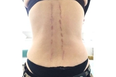 Scoliosi trattata con tecnica mininvasiva: risultato estetico