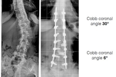 Scoliosi trattata con tecnica mininvasiva: risultati piano coronale