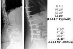 Scoliosi trattata con tecnica mininvasiva: risultati piano sagittale
