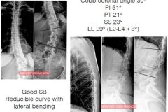 Scoliosi: immagini pre operatorie