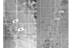 Scoliosi trattata con tecnica mininvasiva: approccio anteriore (OLIF)