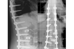 Scoliosi trattata con tecnica mininvasiva: approccio posteriore e fissazione percutanea