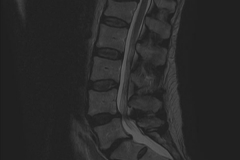 Stenosi segmentaria con instabilità dimostrata - RM rachide lombosacrale