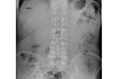 Stenosi segmentaria con instabilità dimostrata - RX lombare-antero-posteriore