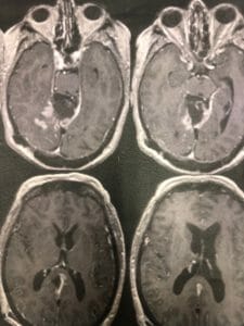 Meningioma falco tentoriale post operatorio zoom