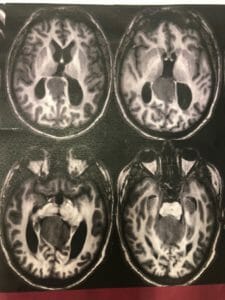 Meningioma falco tentoriale pre operazione